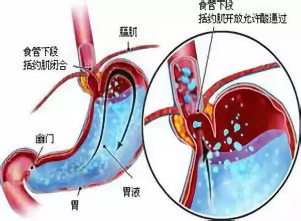 肠胃问题，能否治愈与癌变风险解析