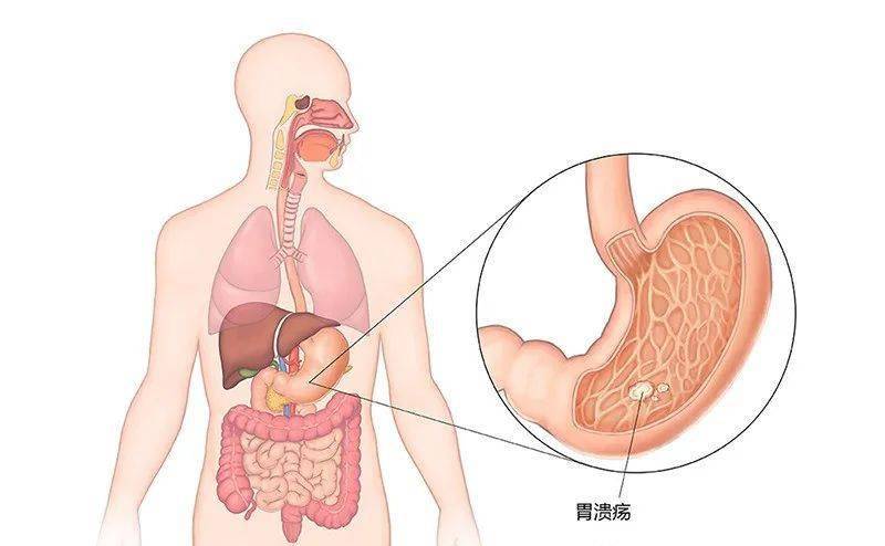 功能性肠胃紊乱症状的全面解析与治疗策略