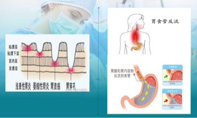 肠胃功能性紊乱，能否自愈的探索之旅