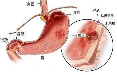 肠胃功能性紊乱的全面解析与治疗指南