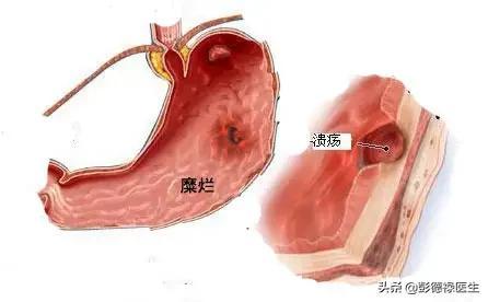 肠胃不消化，肚子咕咕叫与腹胀的背后原因