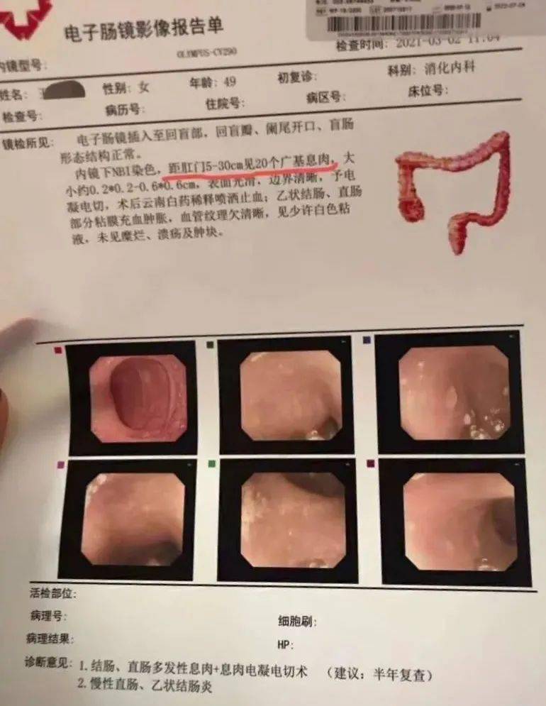 肠胃镜检查发现息肉，应立即处理吗？