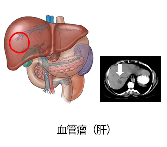 肝脏血管瘤的成因与治疗策略