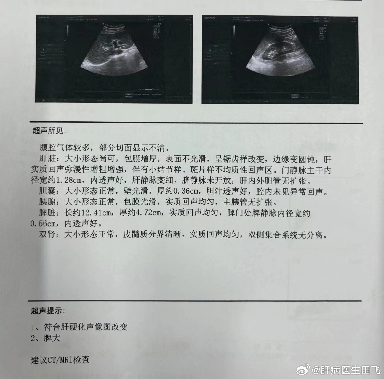 肝脏钙化灶，解读一份不容忽视的医学报告