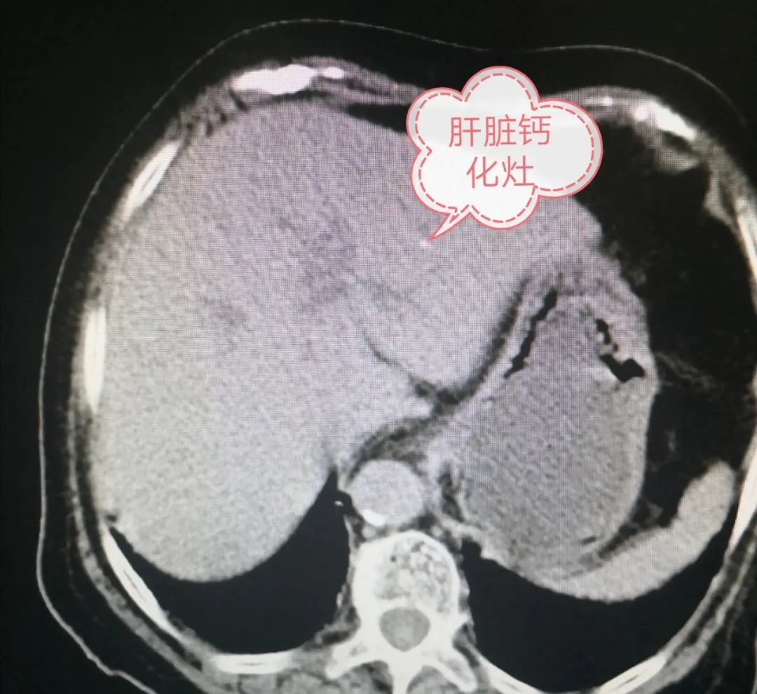 肝脏钙化灶，解读身体内的小石头