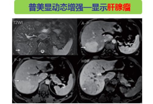 肝脏隐秘的挑战，解读不规则囊肿的奥秘