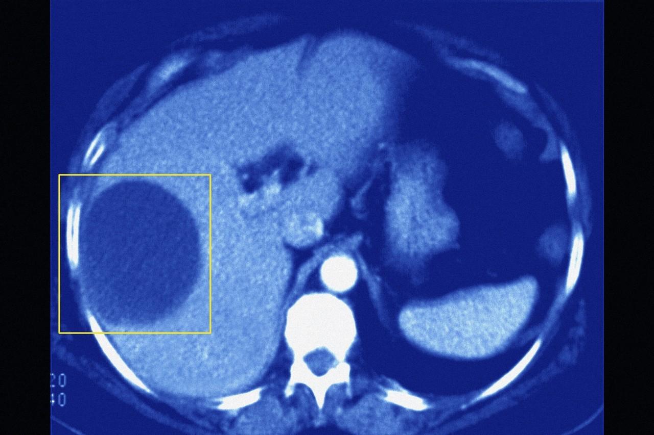 肝脏囊肿，成因、影响与治疗必要性探讨