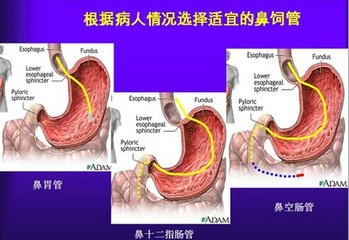 肠胃炎的恢复周期，从症状到康复的全面解析