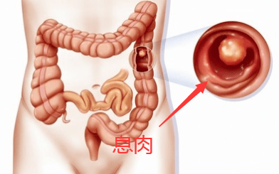 慢性肠胃炎，隐秘的消化系统慢性杀手