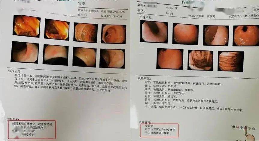 肠胃镜检查中直接切除息肉的实践与考量