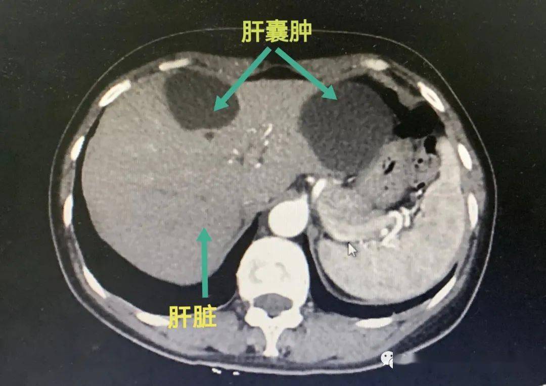 肝脏上有囊肿，了解、诊断与应对策略