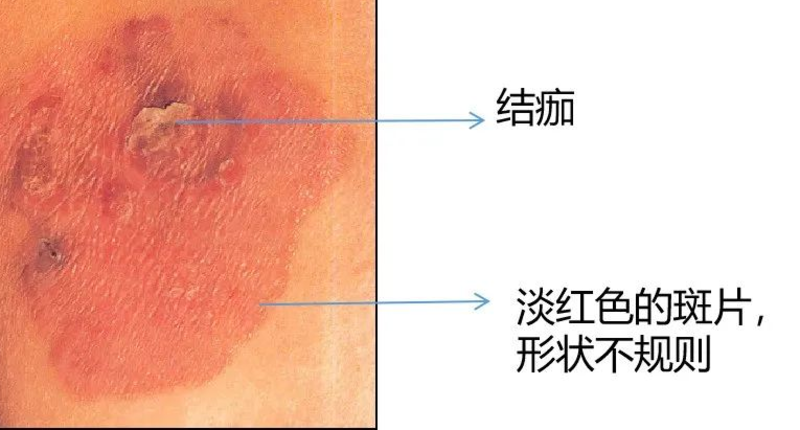 皮肤癌，了解其严重性，但不必过度恐慌