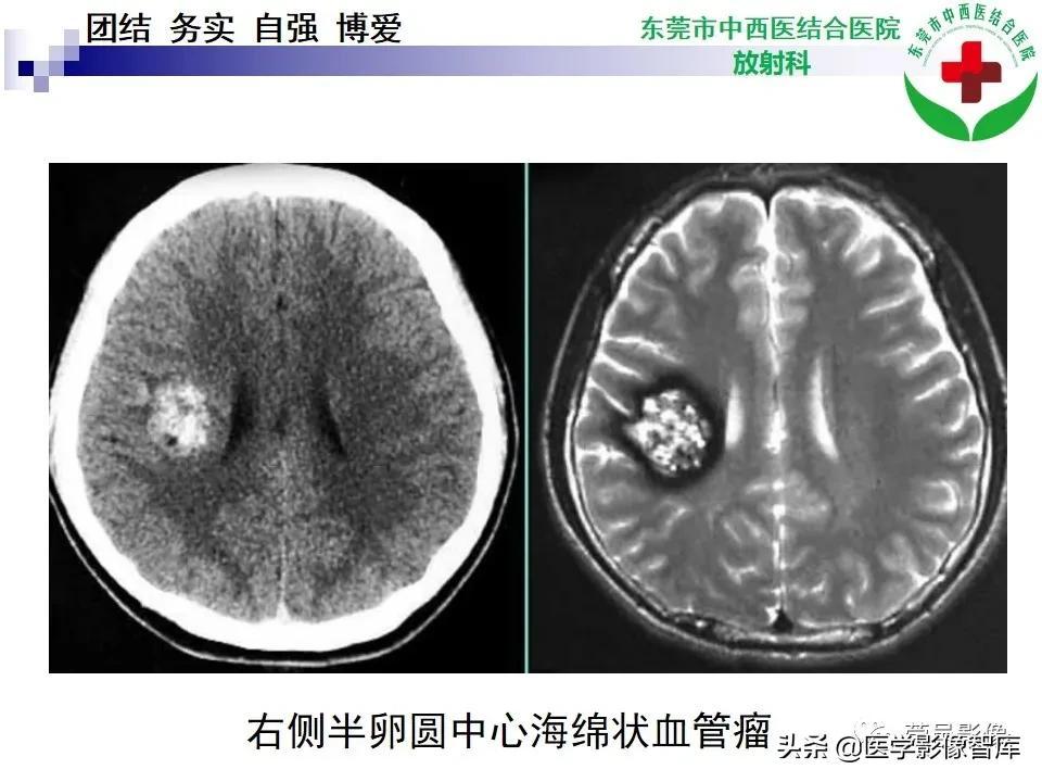 肝脏海绵状血管瘤，了解、诊断与治疗