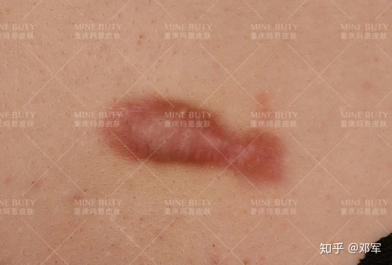 手术后疤痕疙瘩的消除与护理，科学方法与日常护理指南