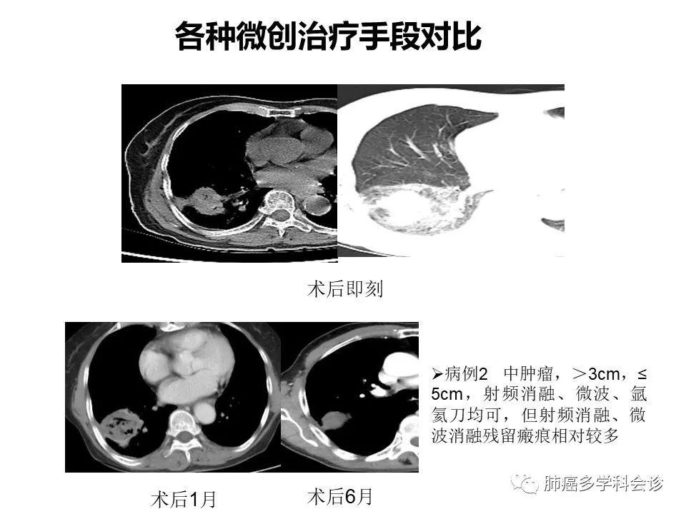全国顶尖，探索治疗肺癌的最佳医院