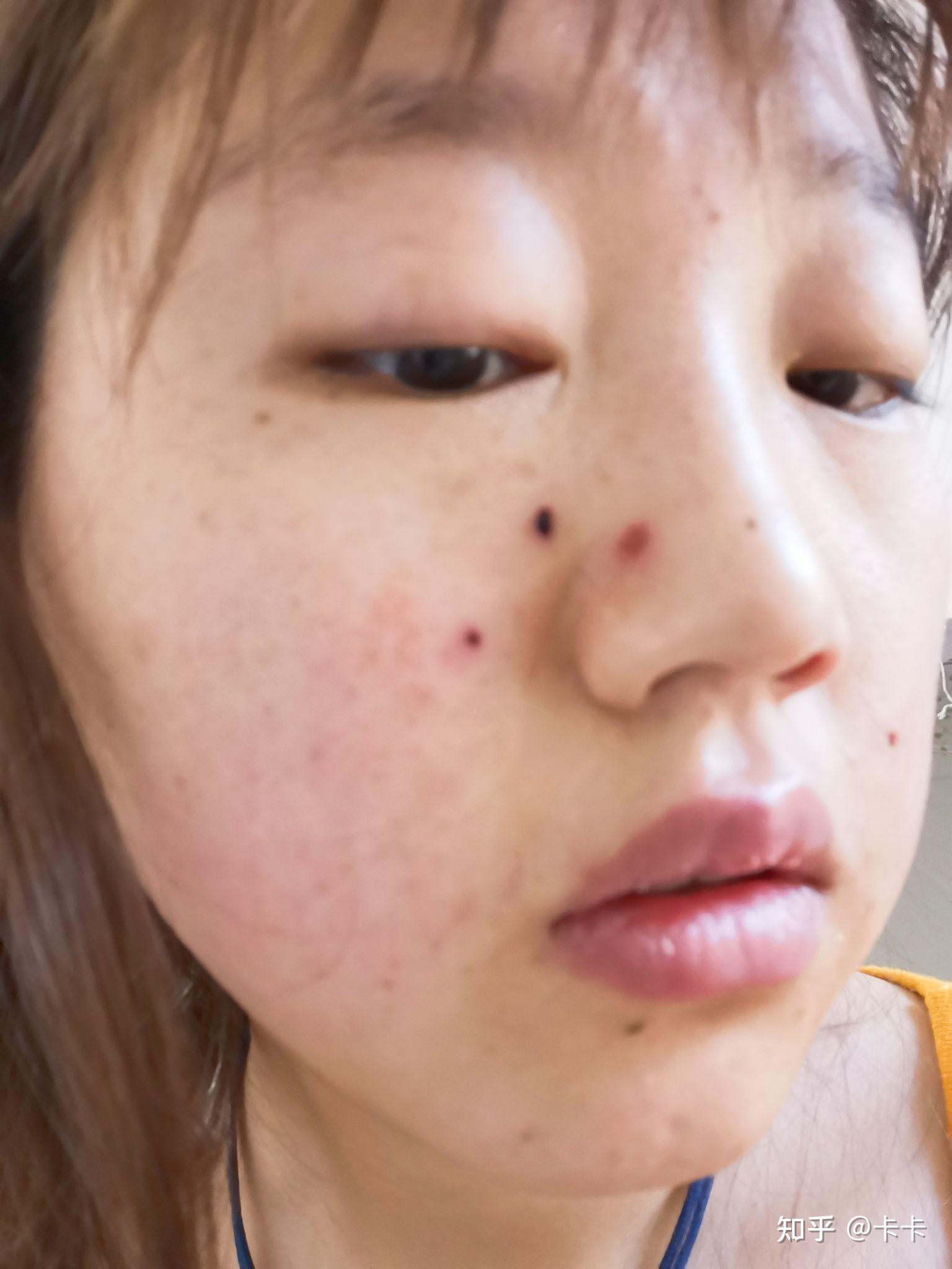医院点痣的价格与医保政策解析