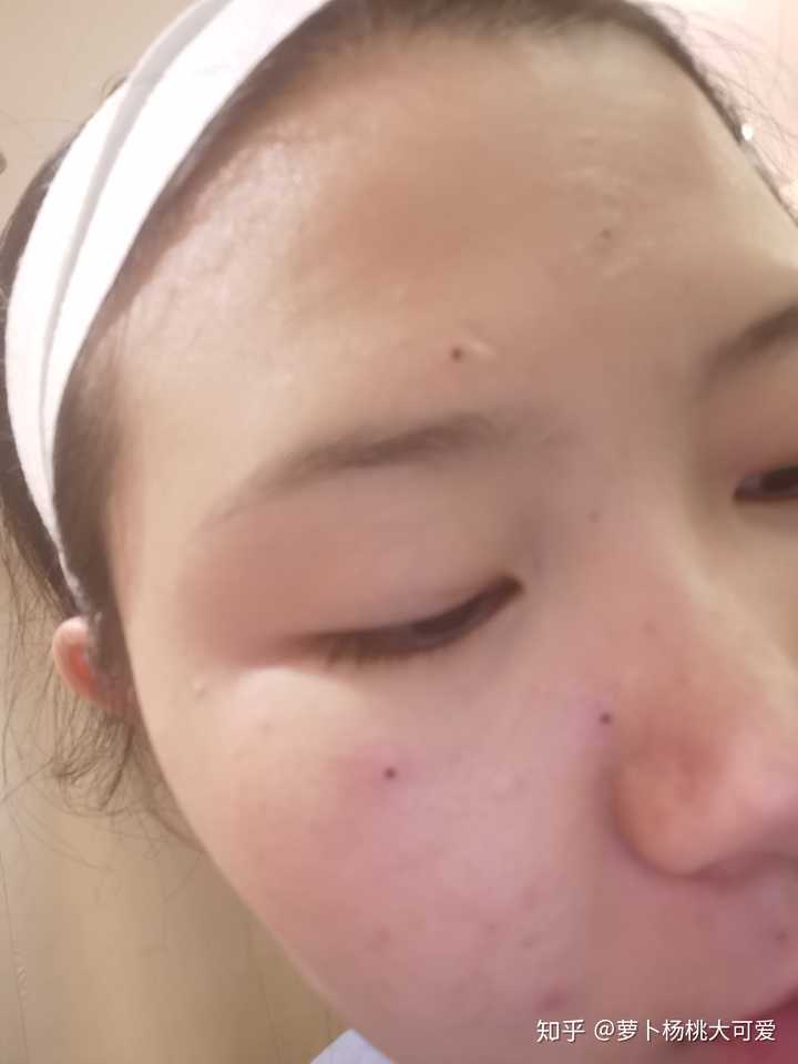 医院点痣，肉痣去除的详细指南及费用解析
