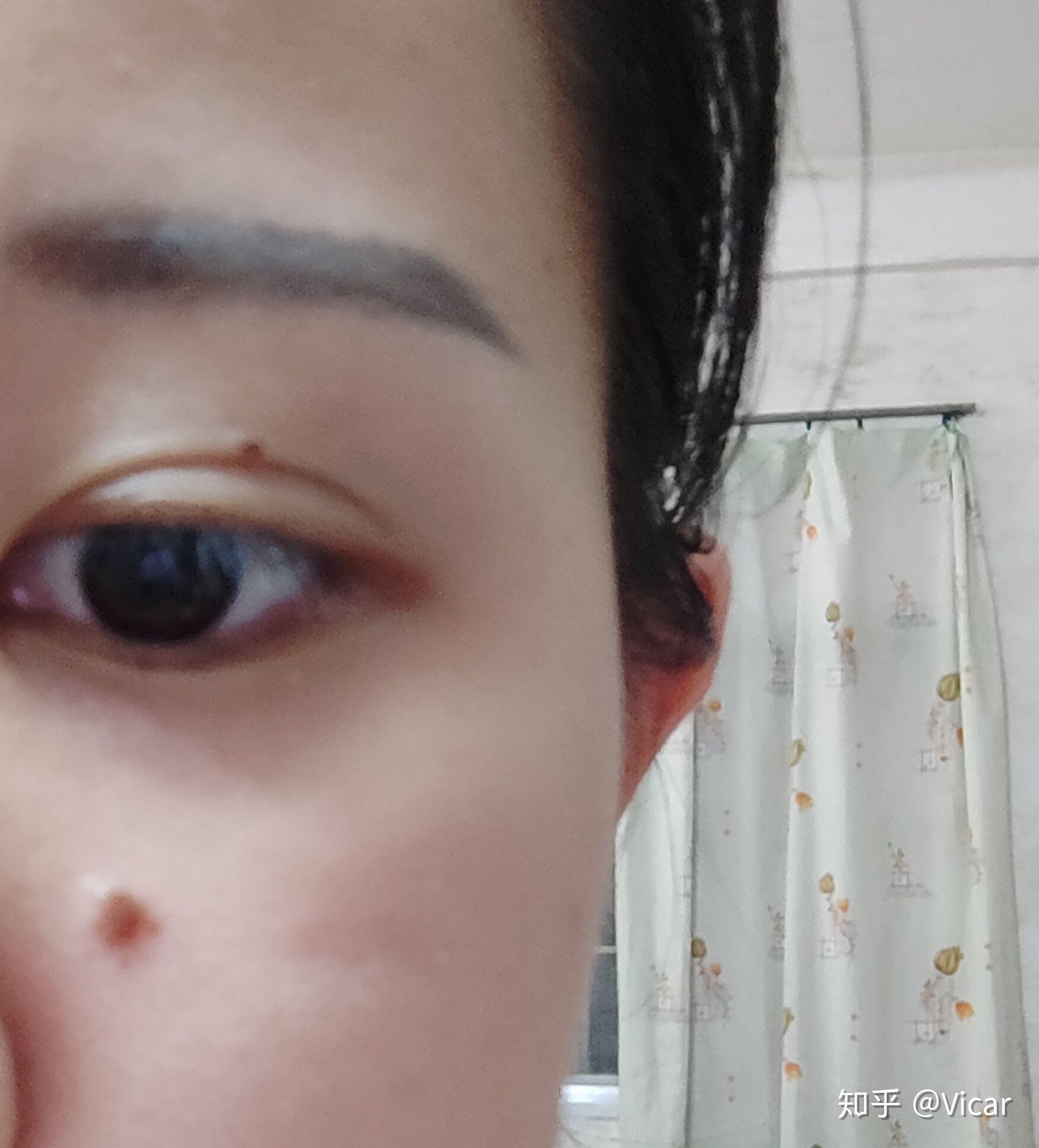医院点痣价格全解析，从费用构成到性价比的深度剖析