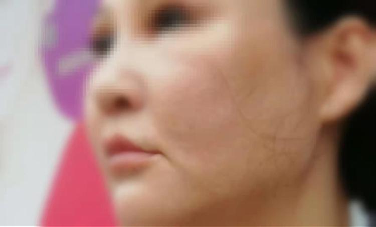 正规医院点痣价格解析，全面了解与选择