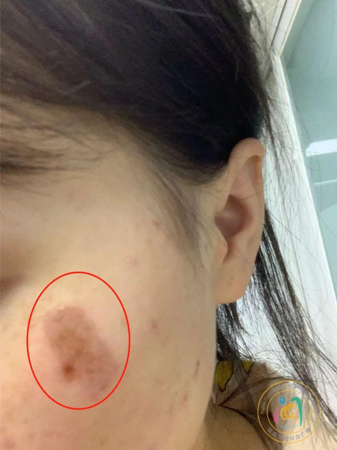 医院点痣的价格与价值，一次全面解析