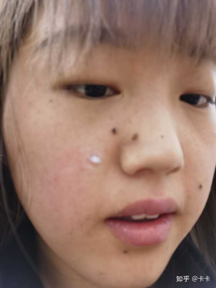 去医院点痣，挂号指南与费用解析
