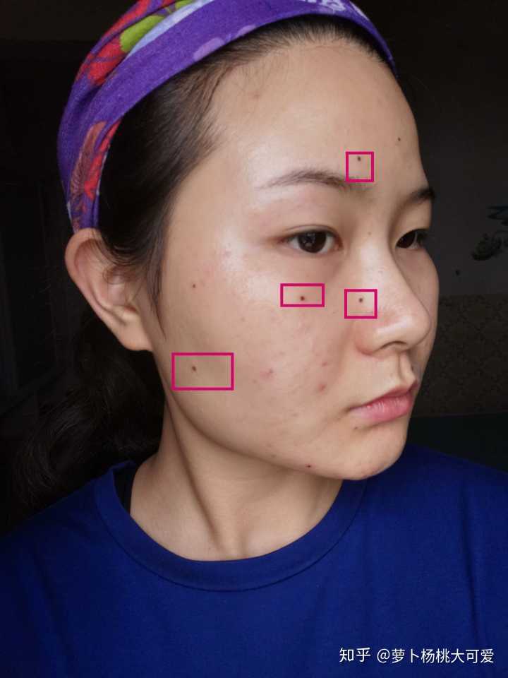 点痣就医指南，挂号科室与费用解析