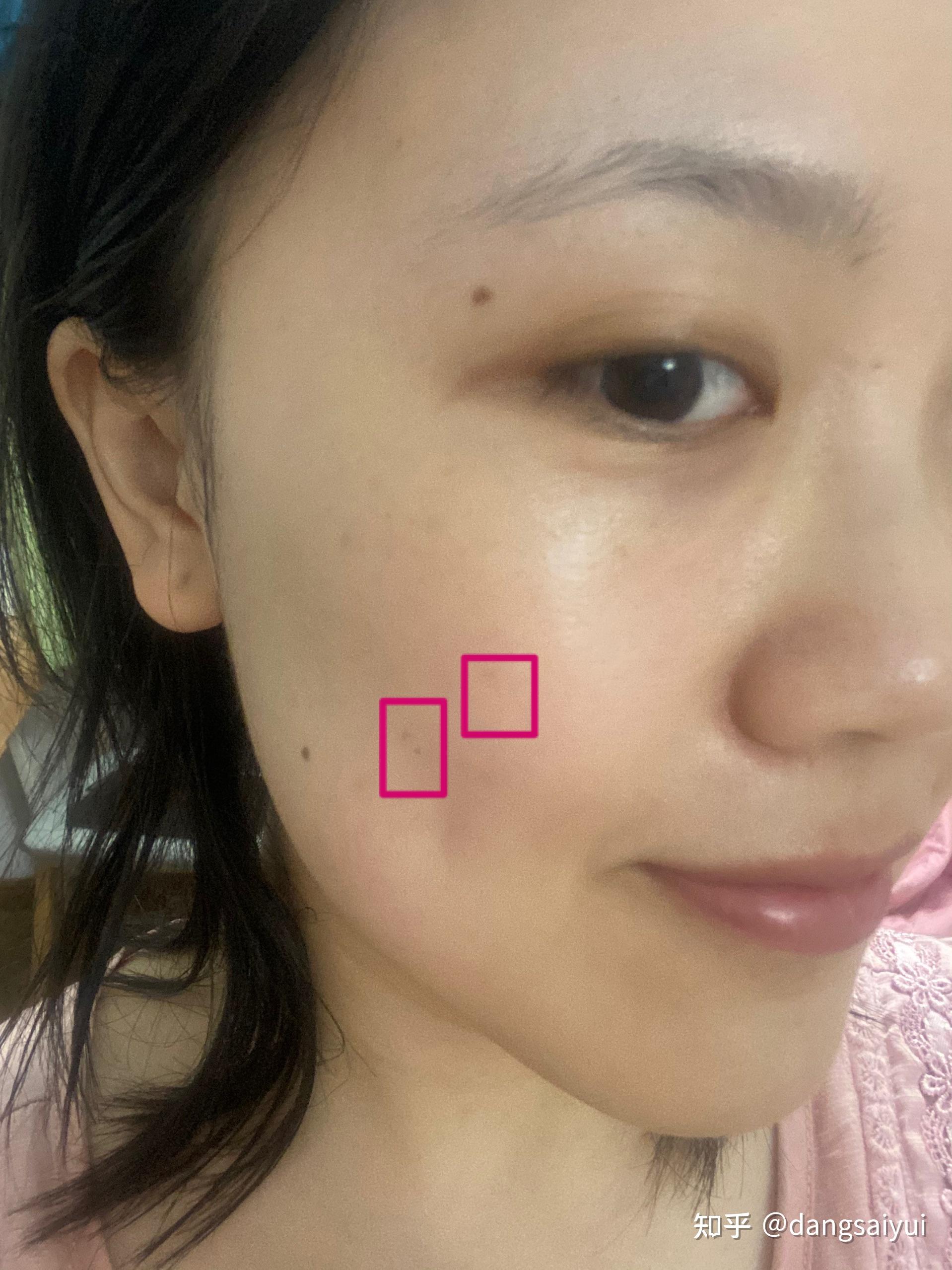 点痣就医指南，选择科室与费用解析