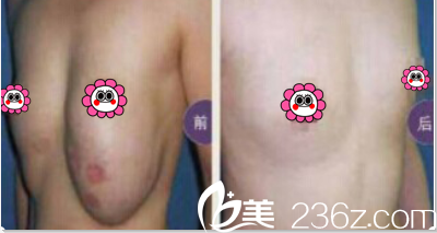 医院取痣的价格，影响因素与大致费用解析