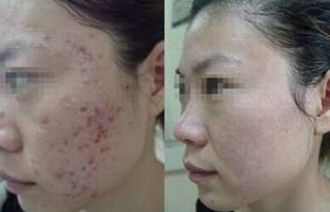 点痣去医院大概多少钱一颗？——全面解析与注意事项